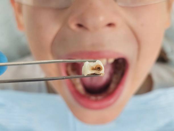 Best Emergency Wisdom Tooth Extraction in Oakland Park, FL
